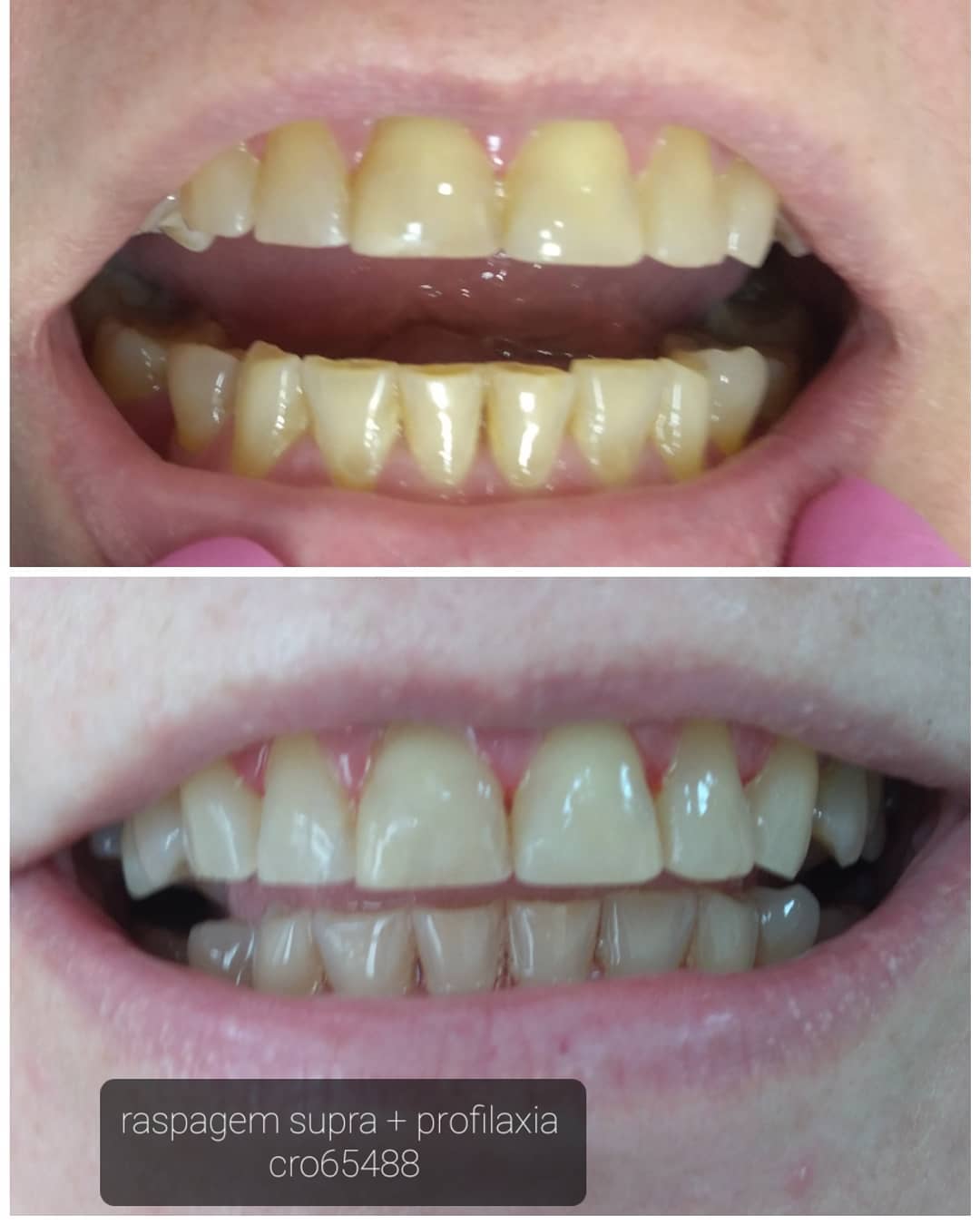 Clareamento e Limpeza (antes e depois)